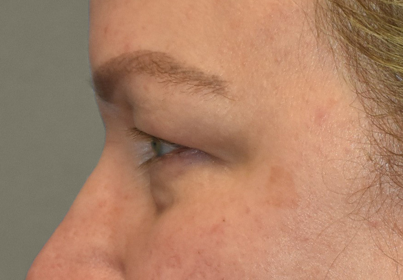 BLEPHAROPLASTY Before & After Gallery - Patient 225256 - Image 9