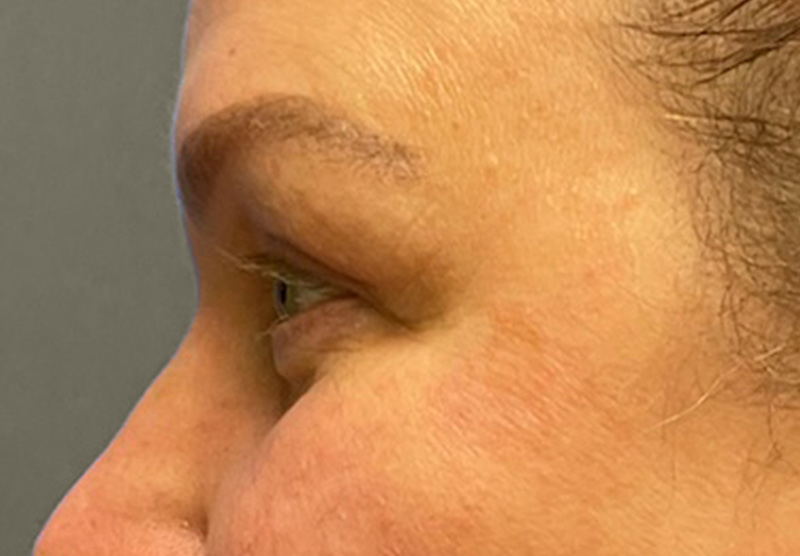BLEPHAROPLASTY Before & After Gallery - Patient 225256 - Image 10