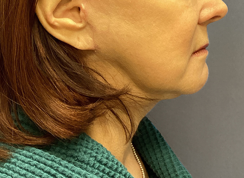 SUBMENTAL LIPOSUCTION Before & After Gallery - Patient 106721 - Image 2