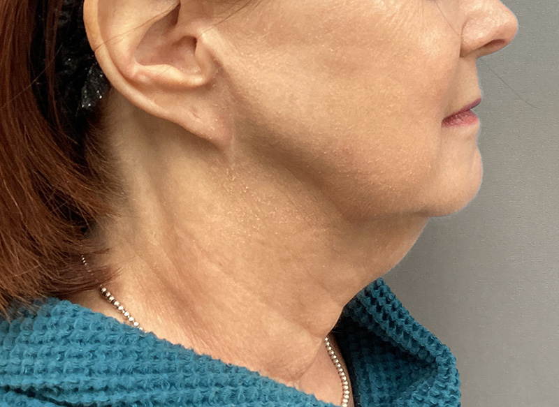 SUBMENTAL LIPOSUCTION Before & After Gallery - Patient 106721 - Image 1