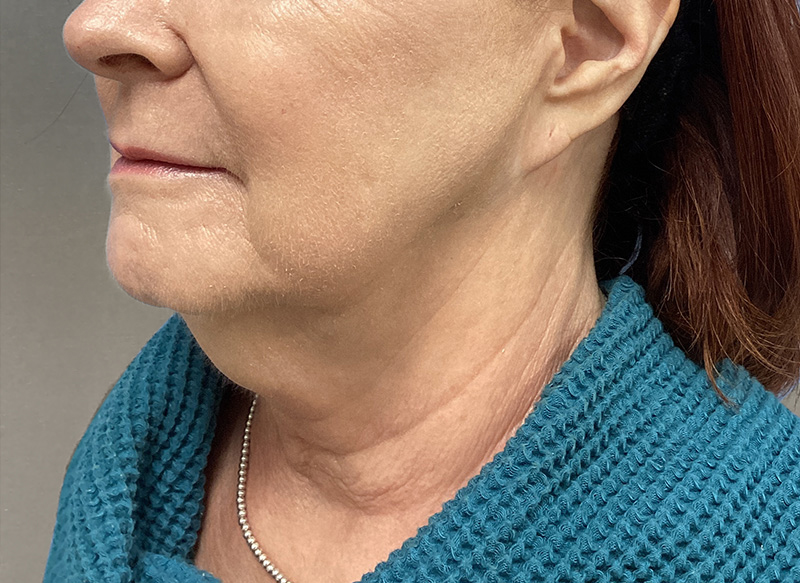 SUBMENTAL LIPOSUCTION Before & After Gallery - Patient 106721 - Image 7