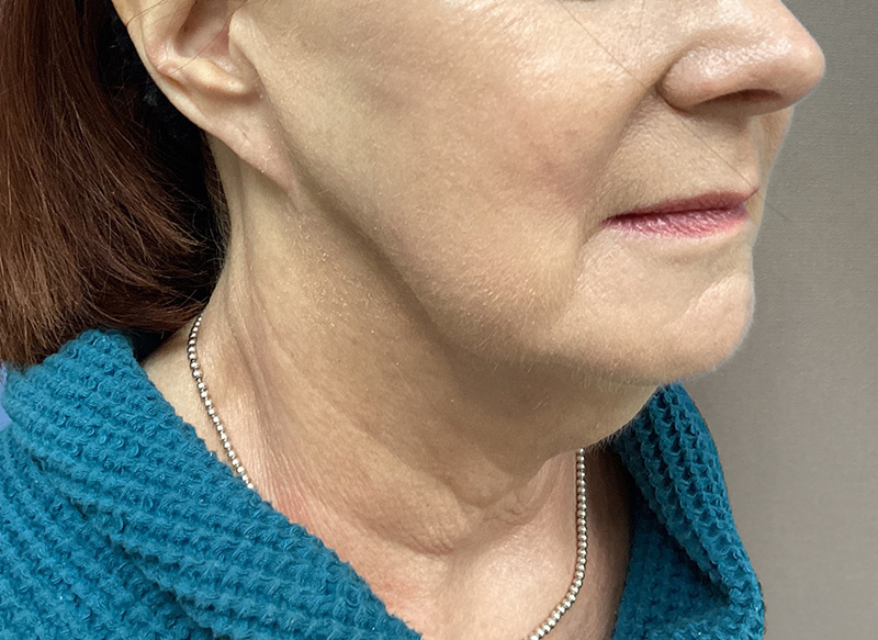 SUBMENTAL LIPOSUCTION Before & After Gallery - Patient 106721 - Image 3