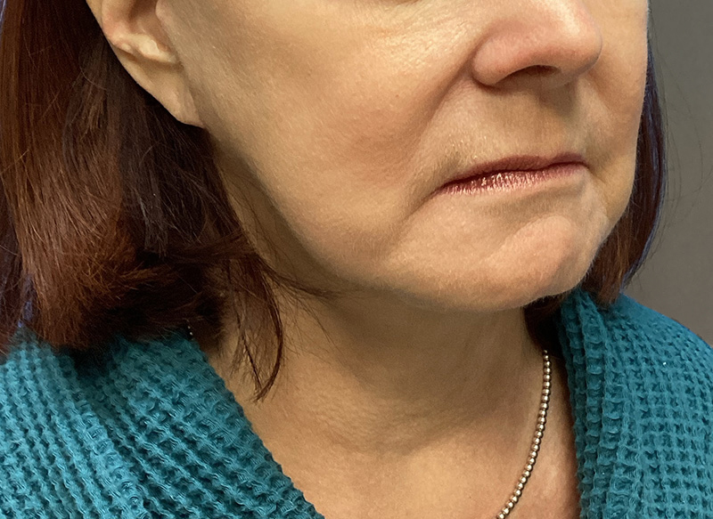 SUBMENTAL LIPOSUCTION Before & After Gallery - Patient 106721 - Image 4