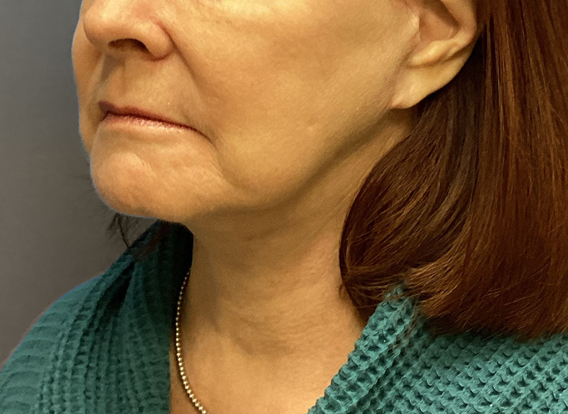 SUBMENTAL LIPOSUCTION Before & After Gallery - Patient 106721 - Image 8