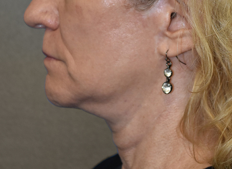 SUBMENTAL LIPOSUCTION Before & After Gallery - Patient 138990 - Image 1