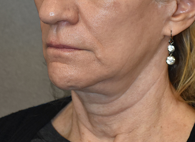 SUBMENTAL LIPOSUCTION Before & After Gallery - Patient 138990 - Image 3