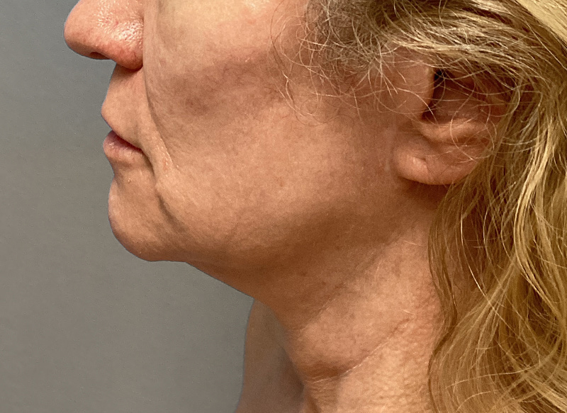 SUBMENTAL LIPOSUCTION Before & After Gallery - Patient 138990 - Image 2