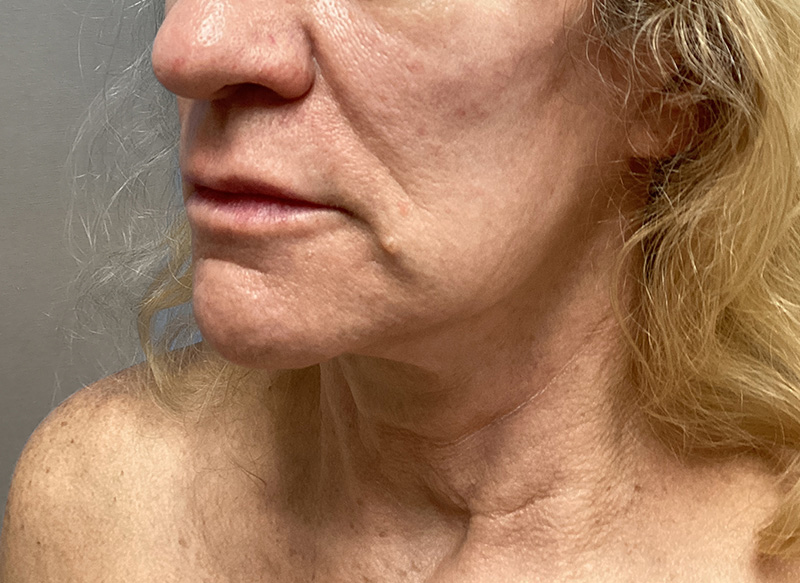 SUBMENTAL LIPOSUCTION Before & After Gallery - Patient 138990 - Image 4