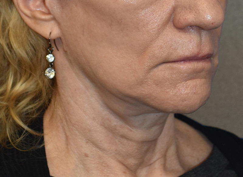 SUBMENTAL LIPOSUCTION Before & After Gallery - Patient 138990 - Image 7