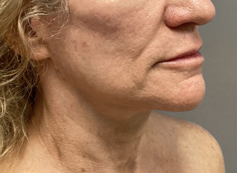 SUBMENTAL LIPOSUCTION Before & After Gallery - Patient 138990 - Image 8