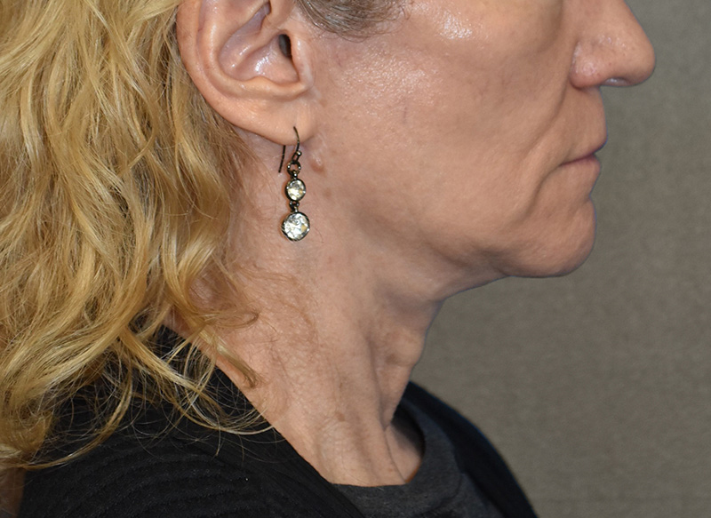 SUBMENTAL LIPOSUCTION Before & After Gallery - Patient 138990 - Image 9