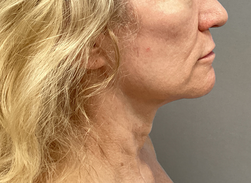 SUBMENTAL LIPOSUCTION Before & After Gallery - Patient 138990 - Image 10