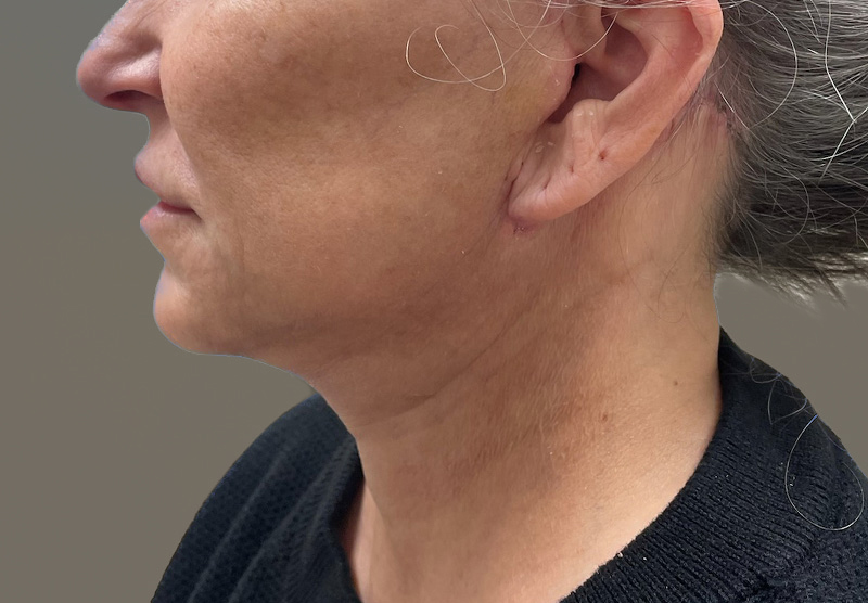 SUBMENTAL LIPOSUCTION Before & After Gallery - Patient 167017 - Image 2