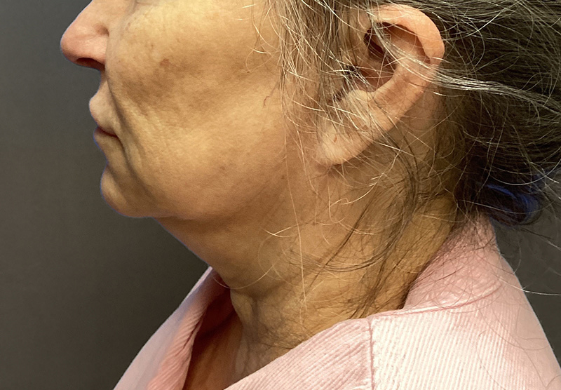 SUBMENTAL LIPOSUCTION Before & After Gallery - Patient 167017 - Image 1