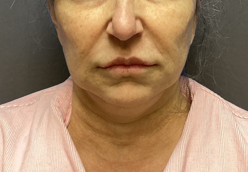 SUBMENTAL LIPOSUCTION Before & After Gallery - Patient 167017 - Image 5