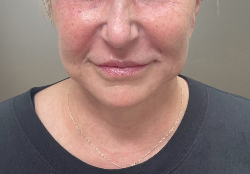 SUBMENTAL LIPOSUCTION Before & After Gallery - Patient 167017 - Image 6