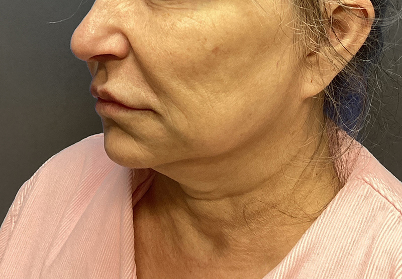 SUBMENTAL LIPOSUCTION Before & After Gallery - Patient 167017 - Image 3