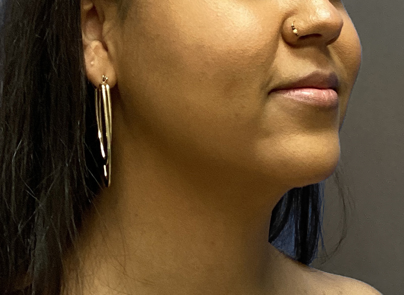 SUBMENTAL LIPOSUCTION Before & After Gallery - Patient 176762 - Image 6