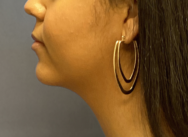 SUBMENTAL LIPOSUCTION Before & After Gallery - Patient 176762 - Image 2