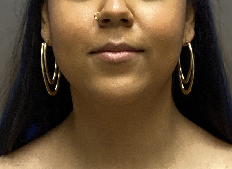 SUBMENTAL LIPOSUCTION Before & After Gallery - Patient 176762 - Image 4