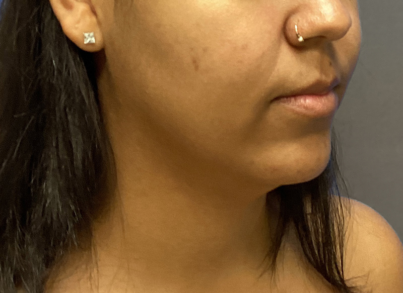 SUBMENTAL LIPOSUCTION Before & After Gallery - Patient 176762 - Image 5