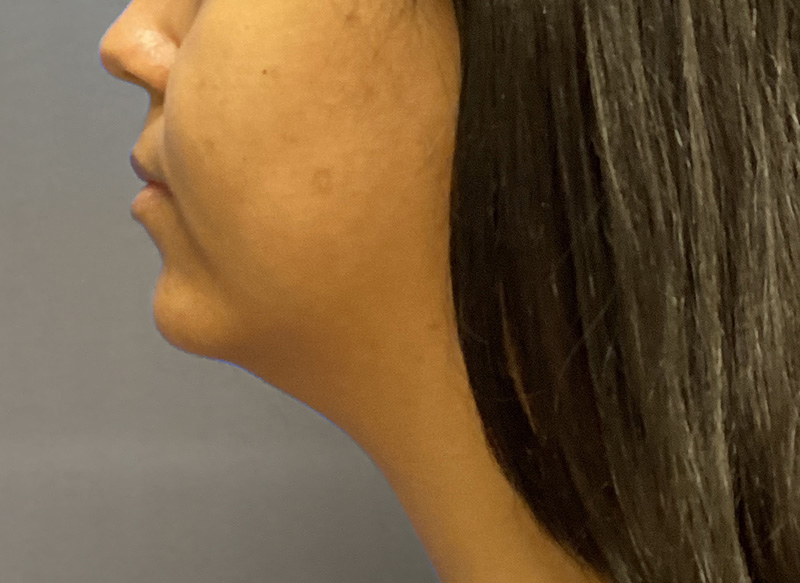 SUBMENTAL LIPOSUCTION Before & After Gallery - Patient 176762 - Image 1