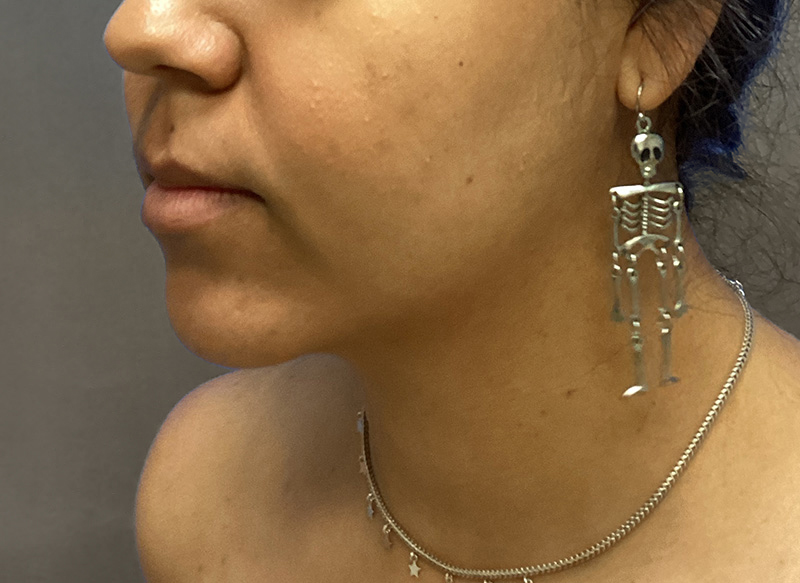 SUBMENTAL LIPOSUCTION Before & After Gallery - Patient 176762 - Image 8