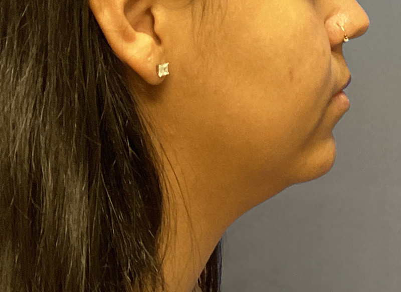 SUBMENTAL LIPOSUCTION Before & After Gallery - Patient 176762 - Image 9