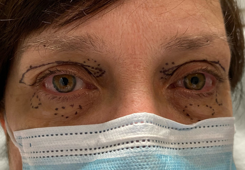 BLEPHAROPLASTY Before & After Gallery - Patient 293146 - Image 1