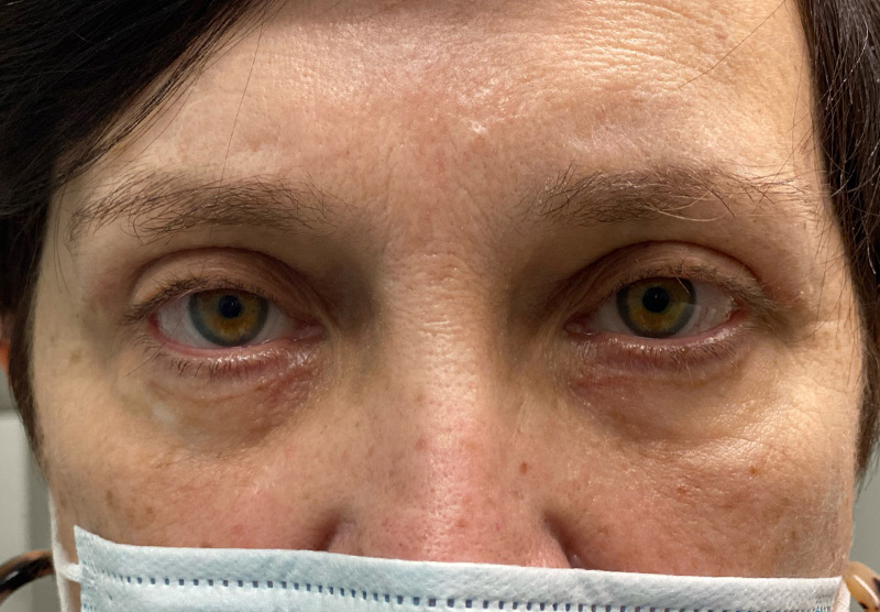 BLEPHAROPLASTY Before & After Gallery - Patient 293146 - Image 2
