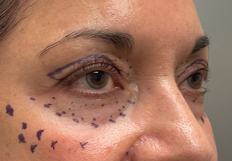 BLEPHAROPLASTY Before & After Gallery - Patient 294435 - Image 3