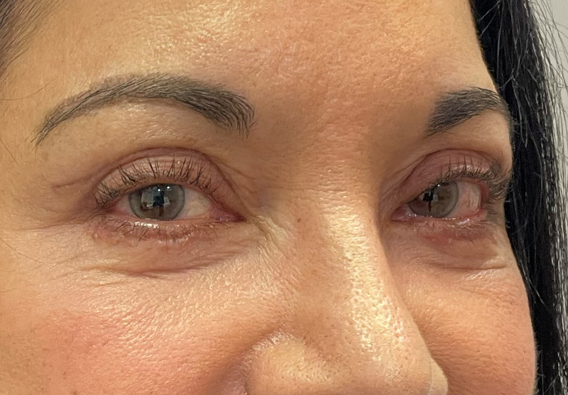 BLEPHAROPLASTY Before & After Gallery - Patient 294435 - Image 4