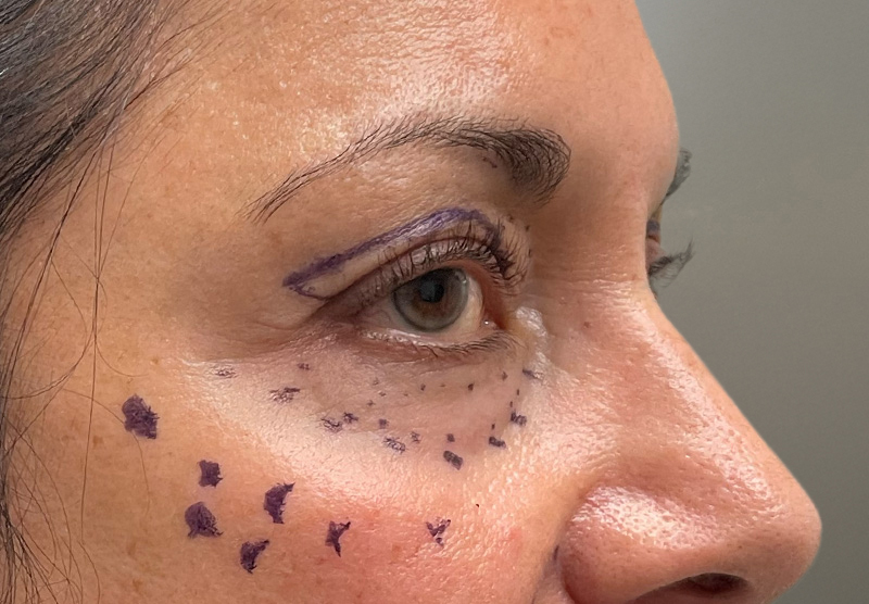 BLEPHAROPLASTY Before & After Gallery - Patient 294435 - Image 5