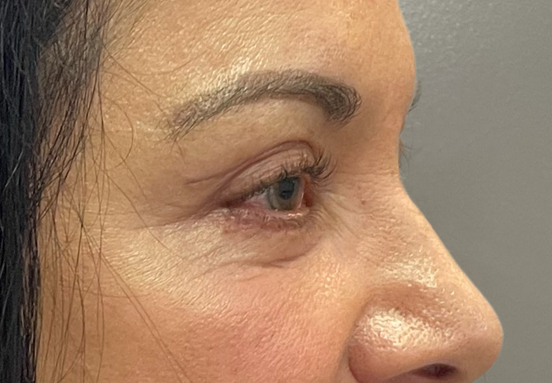 BLEPHAROPLASTY Before & After Gallery - Patient 294435 - Image 6