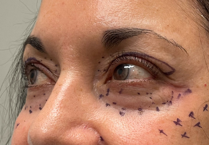 BLEPHAROPLASTY Before & After Gallery - Patient 294435 - Image 7