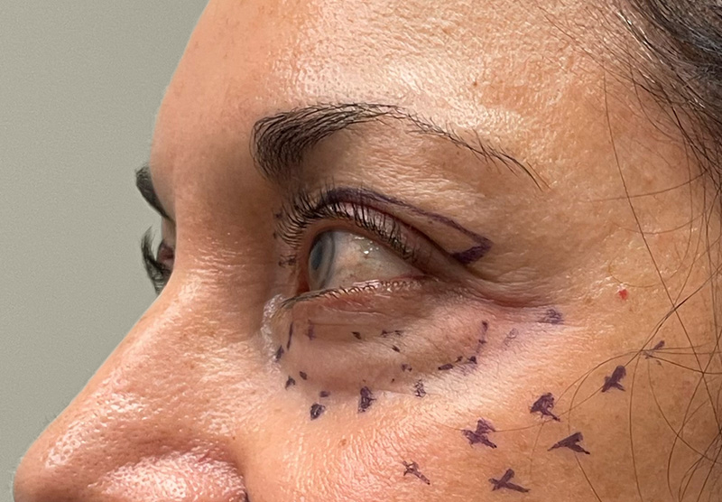 BLEPHAROPLASTY Before & After Gallery - Patient 294435 - Image 9