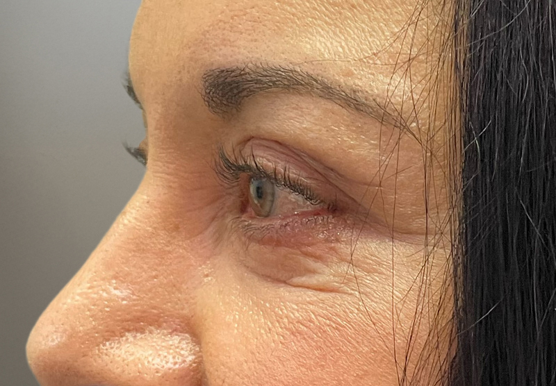 BLEPHAROPLASTY Before & After Gallery - Patient 294435 - Image 10