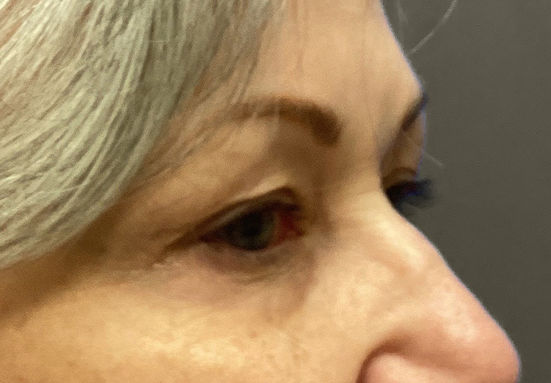 BLEPHAROPLASTY Before & After Gallery - Patient 311510 - Image 3