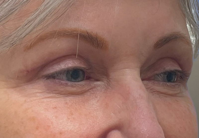 BLEPHAROPLASTY Before & After Gallery - Patient 311510 - Image 4