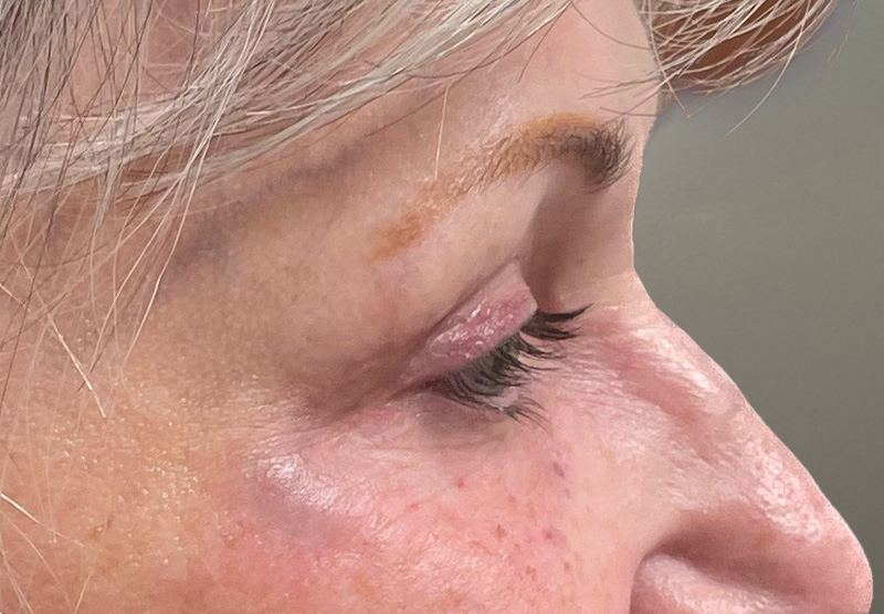 BLEPHAROPLASTY Before & After Gallery - Patient 311510 - Image 6