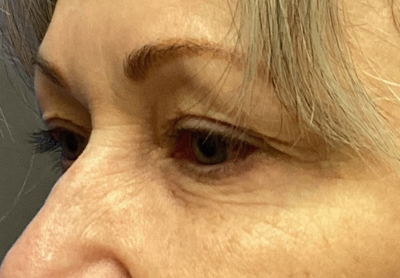 BLEPHAROPLASTY Before & After Gallery - Patient 311510 - Image 7