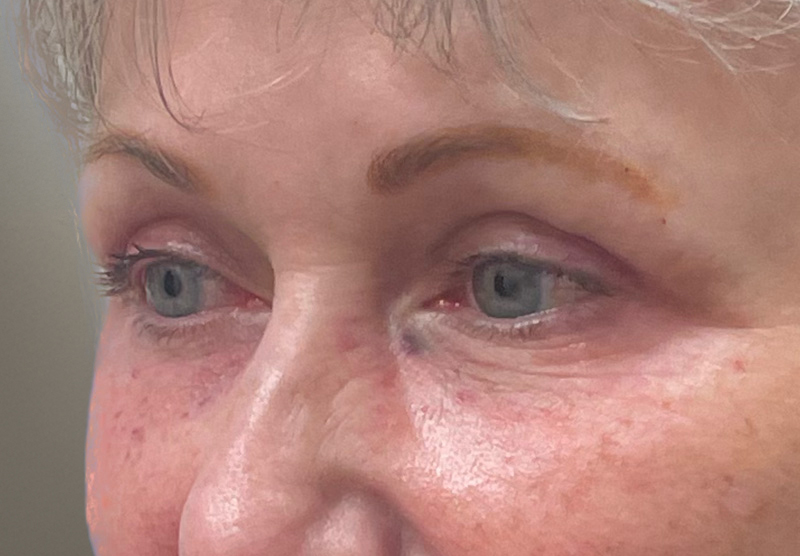 BLEPHAROPLASTY Before & After Gallery - Patient 311510 - Image 8