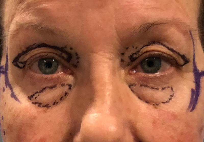 BLEPHAROPLASTY Before & After Gallery - Patient 337189 - Image 1
