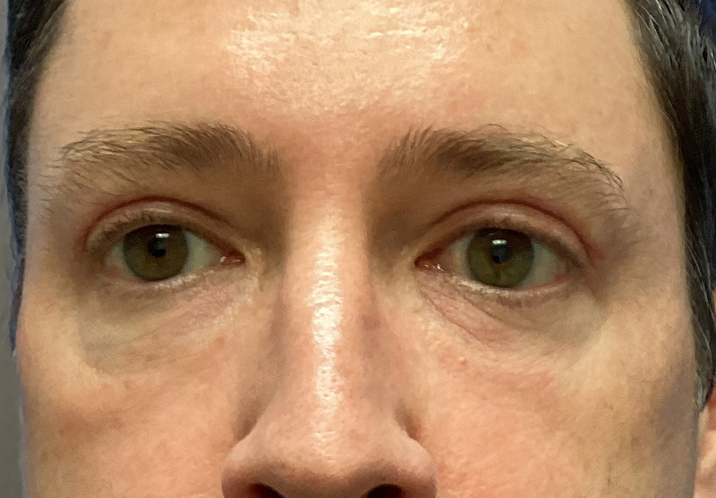 BLEPHAROPLASTY Before & After Gallery - Patient 344008 - Image 2