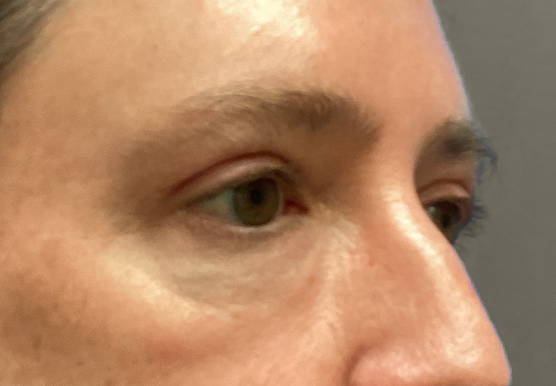 BLEPHAROPLASTY Before & After Gallery - Patient 344008 - Image 4