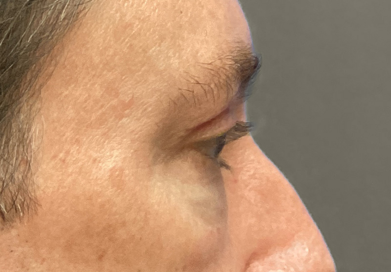 BLEPHAROPLASTY Before & After Gallery - Patient 344008 - Image 6