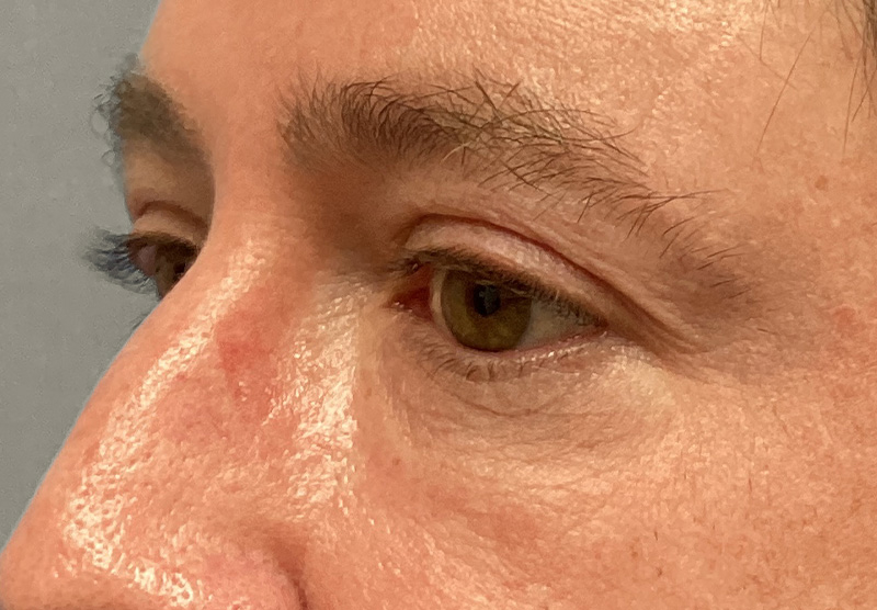 BLEPHAROPLASTY Before & After Gallery - Patient 344008 - Image 7