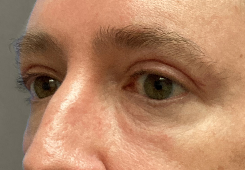 BLEPHAROPLASTY Before & After Gallery - Patient 344008 - Image 8