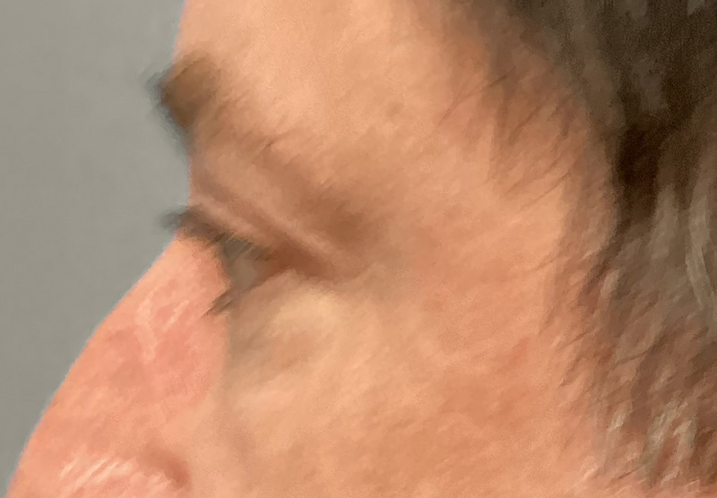 BLEPHAROPLASTY Before & After Gallery - Patient 344008 - Image 9