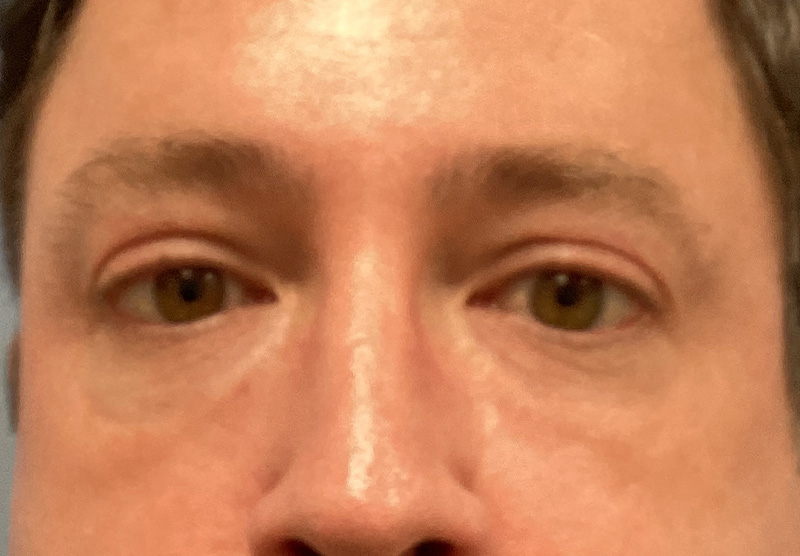 BLEPHAROPLASTY Before & After Gallery - Patient 344008 - Image 1